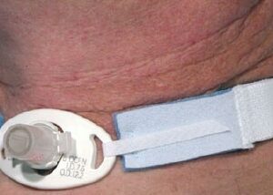 Tracheostomy Tube Holder AirLife Neonate