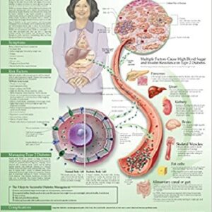 Anatomical Chart Type 2 Diabetes 20 X 26 Inch Heavy Paper Grommets Laminated